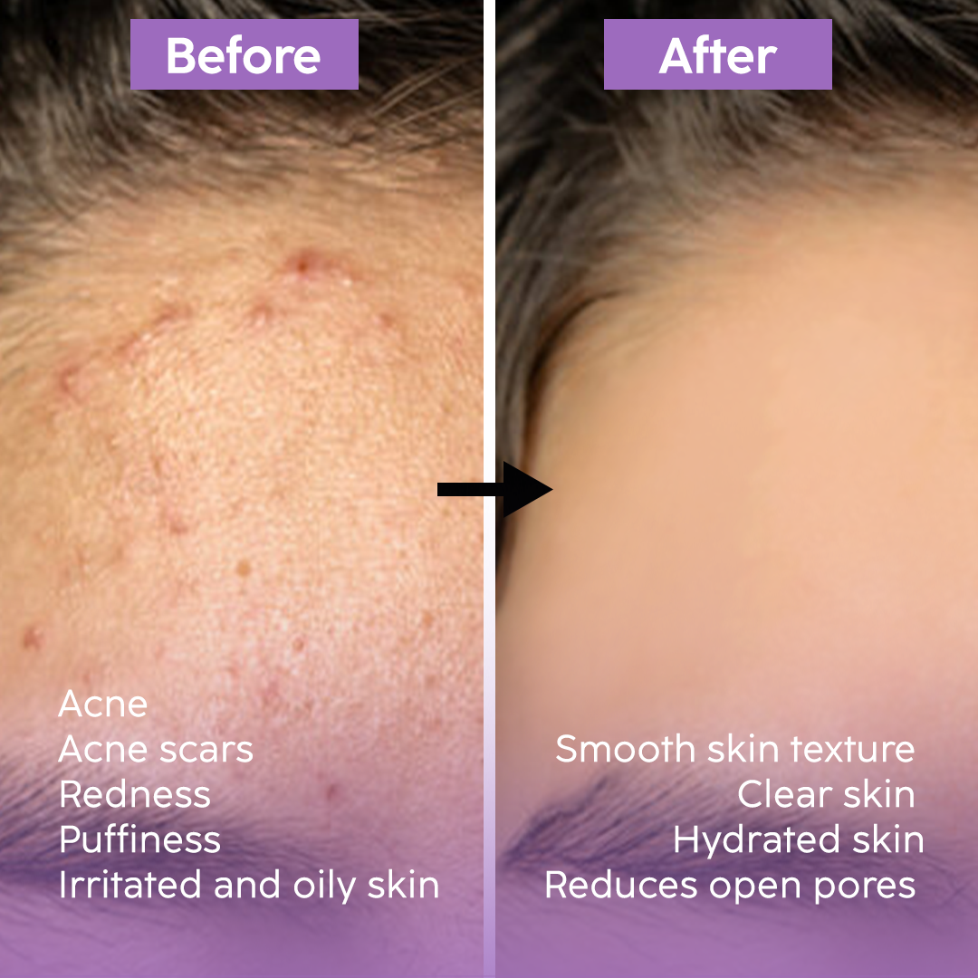 Acne & Open Pore Solution - Bundle Pack