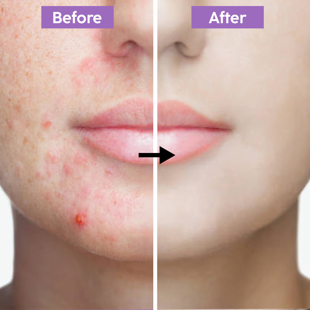 Anti-Acne Neem Face Wash